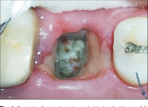 What Should My Gums Look Like After Wisdom Teeth Extraction Teeth Poster