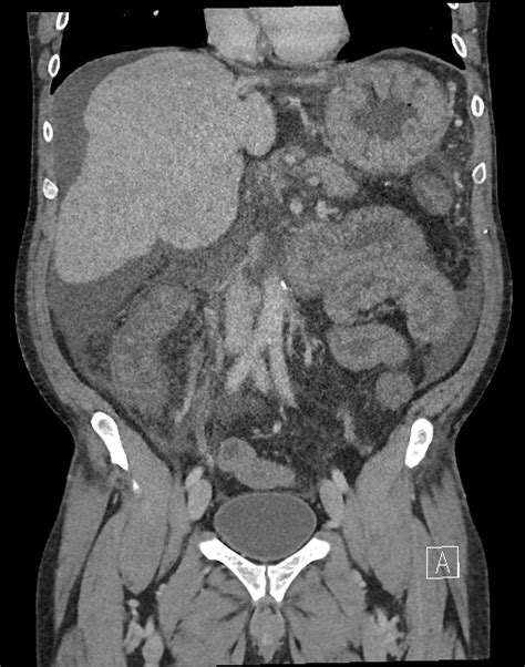 Portal Hypertensive Gastropathy Enteropathy And Colopathy Image