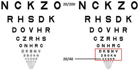 Etdrs Visual Acuity Chart