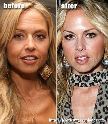 Young lady presented to lift and airbrush forehead and eyes, to soften existing lines and prevent further additional wrinkles from forming. rachel zoe - botox, fillers, nose, brow lift | Before and ...