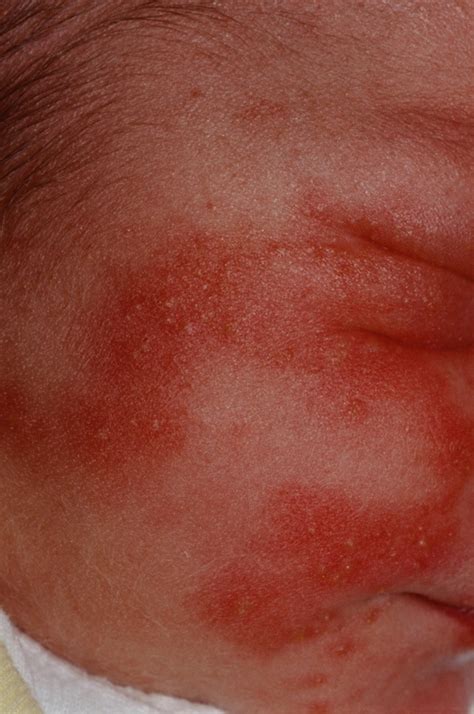 Is It A Rash Or Baby Acne Wehavekids