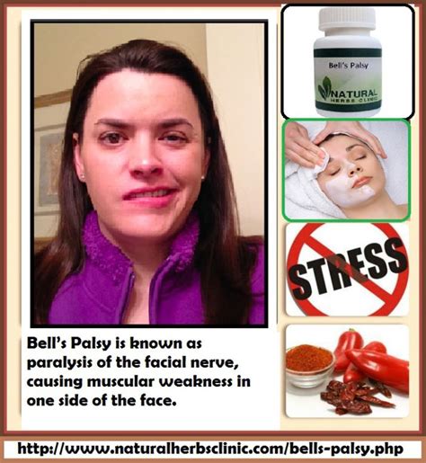Bells Palsy Treatment Facial Exercises Bells Palsy Bells Palsy