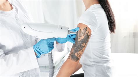 Eliminar Tatuajes Madrid Todo Lo Que Necesitas Saber Comunicare