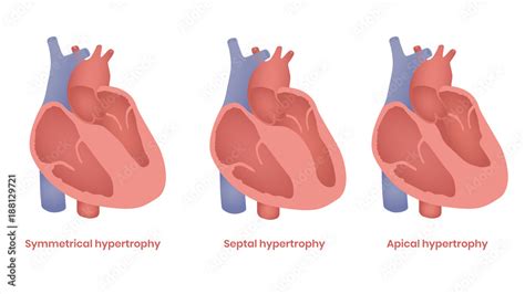 Hypertrophic Cardiomyopathy Illustration Apical Septal And