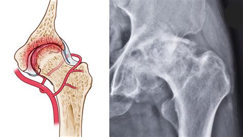 Proximal Femoral Fracture