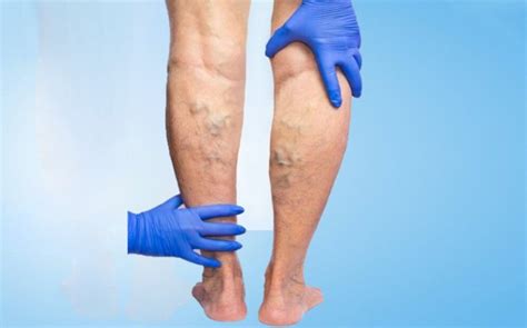 Varicose Veins Treatment Houston Texas We Are Best Dr Fan