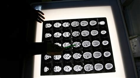 Scientists Using Polio To Treat Brain Cancer