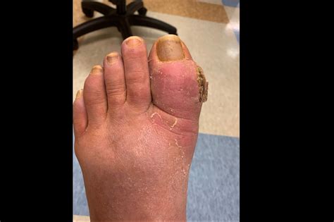 Big Toe Inflammation