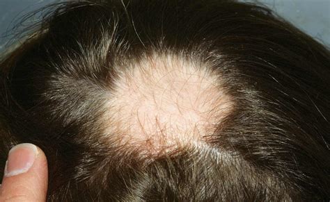 Alopecia Areata Hair Regrowth Spefashion