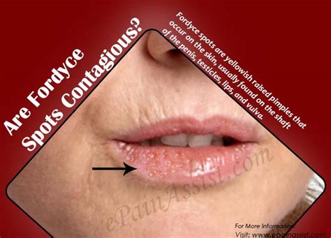 How To Prevent Fordyce Spots On Lips