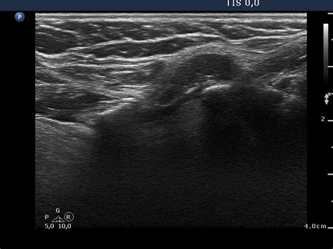 Ultrasound image of a neck mass. Lymph nodes in the neck