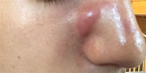 Red Lump On Side Of Nose General Acne Discussion By