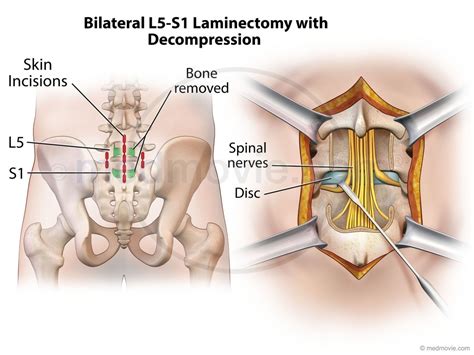 Bilateral L5 S1 Laminectomy With Decompression
