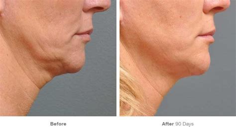 Ultherapy Sydney Skin Tightening Before And After Photos