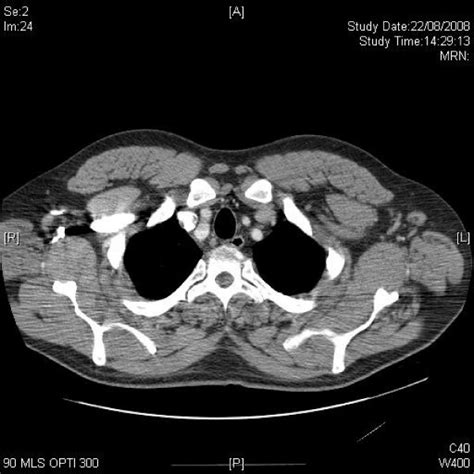 Axial Ct Of Upper Chest Demonstrating Axillary Lymphadenopathy