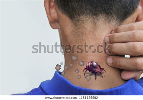 Picture Dust Mites Skin Rashes Dust Stock Photo 1181125582 Shutterstock