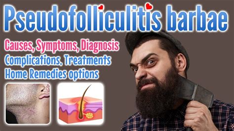 Pseudofolliculitis Barbae Overview Causes Symptoms Diagnosis