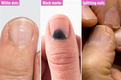 From Arthritis To Anaemia What Your Fingernails Could Tell You About