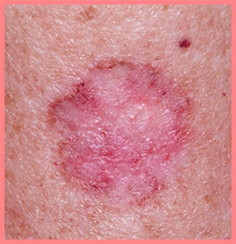 Skin Disease Picture Pictures Photos