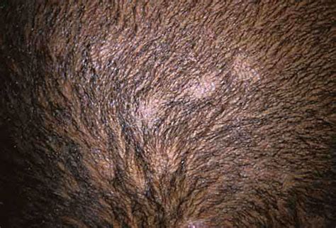 Scalp Ringworm Pictures Sexy Dance