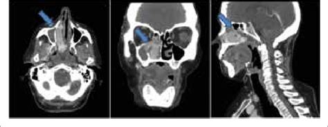 Ct Scan Of The Neck With Contrast Media Axial Corona Sagittal Mpr