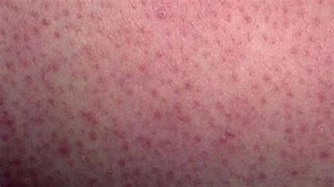 Keratosis Pilaris Results In Red Dots On Legs And Arms