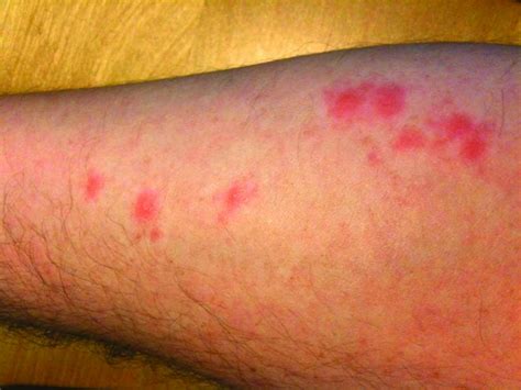 Skin Reactions To Bed Bug Bites Vary 813 922 8475