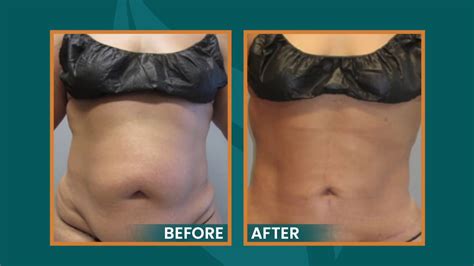 Sono Bello Laser Liposuction Tummy E X Mini Tummy Tuck Youtube