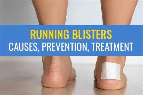Running Blisters Causes Prevention And Treatment