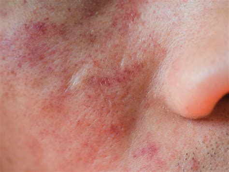 Eczema On Face Symptoms Causes Types Treatment Ph