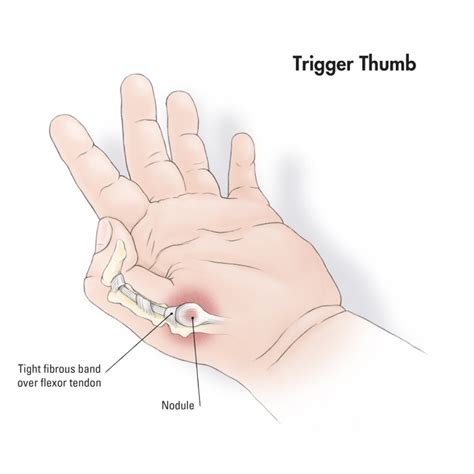 Trigger Thumb Treatment In Kolkata India Kids Orthopedic