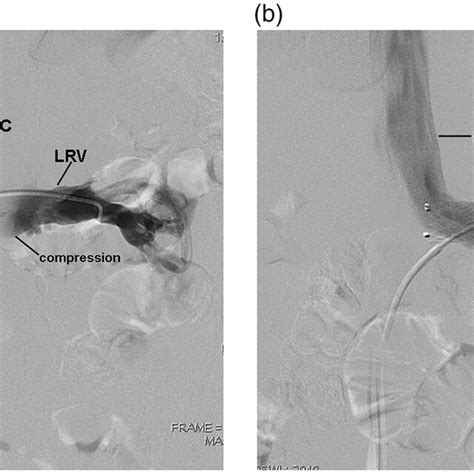 Imaging Manifestations Before And After Endovascular Stent Placement