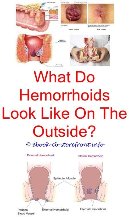 12 Mind Blowing Hemorrhoid Diet Watches Ideas Bleeding Hemorrhoids