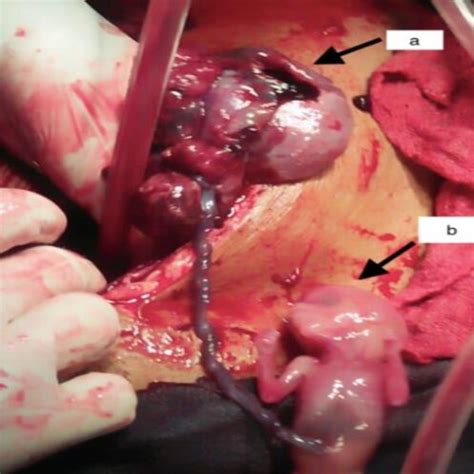 Intraoperative Finding A Ruptured Ampulla Of Left Fallopian Tube And