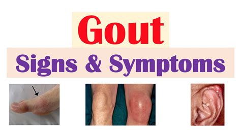 Gout Signs And Symptoms And Why They Occur Youtube