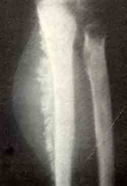 Остеогенная саркома (симптом игольчатого периостита) - Новообразования Картинка - Остеогенная саркома (симптом игольчатого периостита) - Новообразования