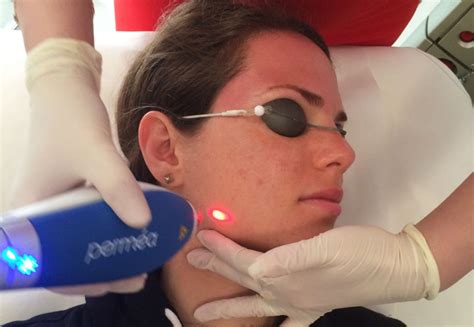 Clear Brilliant Laser Review Can Laser Treatments Make Your Skin