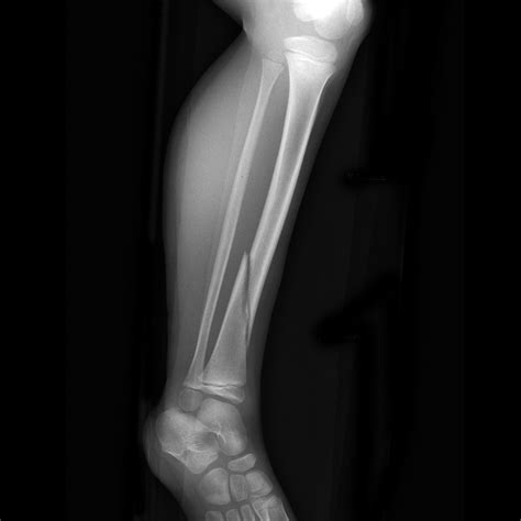 Tibial Spiral Fracture Image
