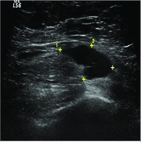 B Ultrasound Image Of The Same Patients Right Axillary Region At