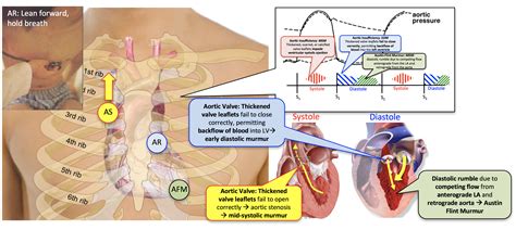 Aortic Regurgitation Murmur Pathophysiology Treatment