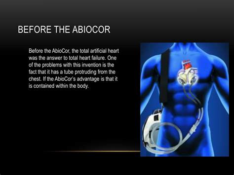 Ppt Abiocor The Artifical Heart Powerpoint Presentation Free