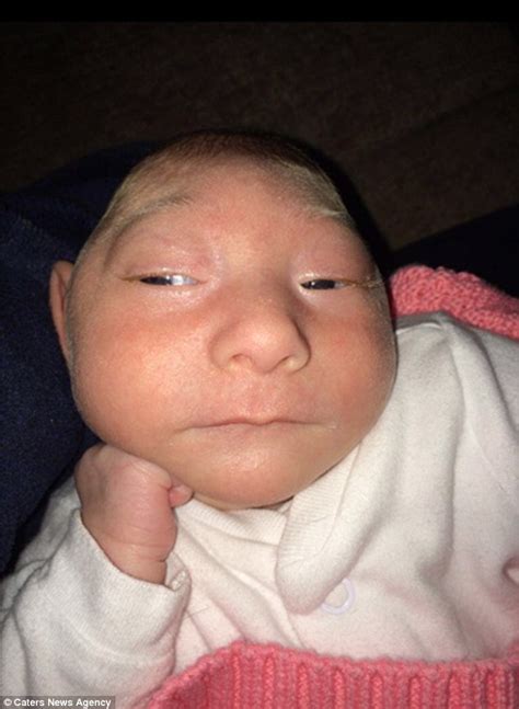 The Baby Born With Brain Outside Of Her Skull Has Survived Defying All