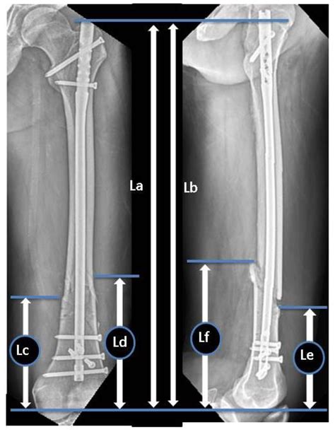 Jcm Free Full Text Perioperative Radiographic Predictors Of Non