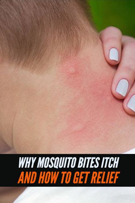 Why Mosquito Bites Itch Mosquito Bite Itch Mosquito Bite Cure
