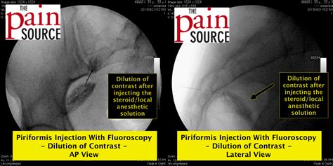 Piriformis Muscle Injection With Fluoroscopy The Pain Source Makes The Best Porn Website