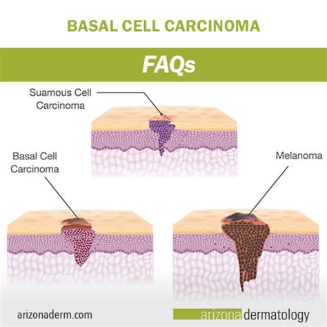Beginning Stages Of Basal Cell Carcinoma