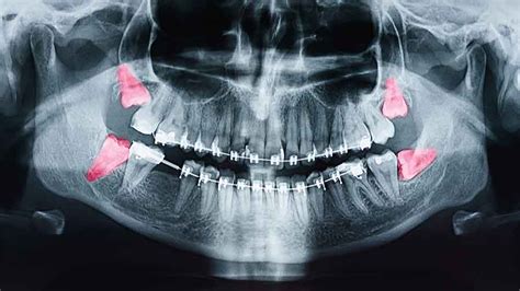 Complications From Not Removing Problem Wisdom Teeth Lafayette