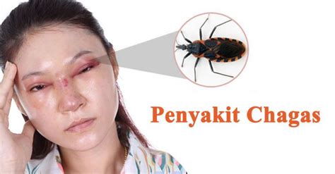 Mengenal Penyakit Chagas Sinergimsas Net