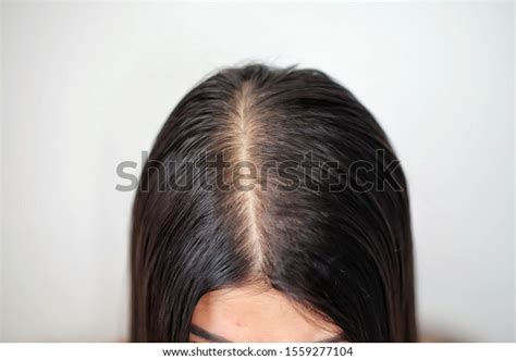Women Thin Hair There Pulses Hair Stock Photo 1559277104 Shutterstock