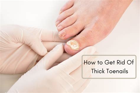 How To Get Rid Of Thick Toenails With Top 5 Home Remedies